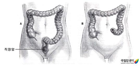 복회음절제술의 도식 - 직장암
