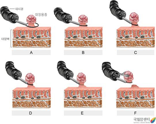 대장암의 내시경적 용종 절제술 - 내시경, 대장용종, 대장벽,   6단계로 구성