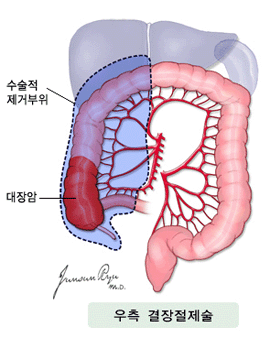 대장암 : 우측 결장절제술 - 대장암, 수술적 제거 부위