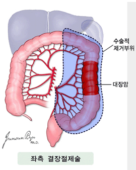 대장암 : 좌측 결장절제술 - 대장암, 수술적 제거부위