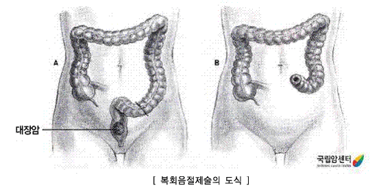 대장암 : 복회음절제술의 도식