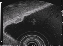 위유암종의 내시경 초음파 사진