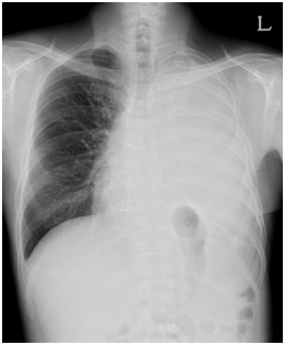 흉막외 전폐절제술을 시행 받은 환자의 흉부 방사선 사진