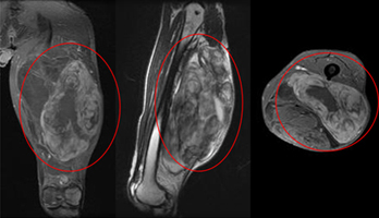 대퇴부에 발생한 악성 섬유성 조직구종(Malignant Fibrous Histiocytoma) 환자의 관상면, 시상면, 축면 MRI소견