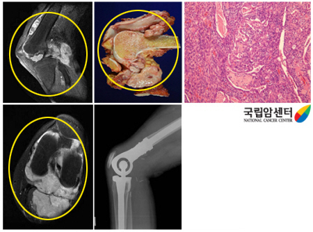 왼쪽 무릎관절 주위에 발생된 활막육종 환자의 사진