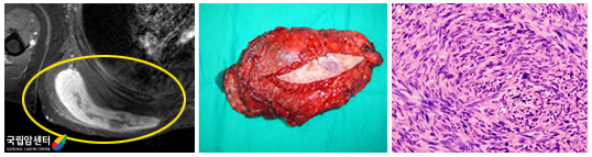오른쪽 견갑부 주위 악성섬유성조직구종 환자의 수술적 절제술 사진