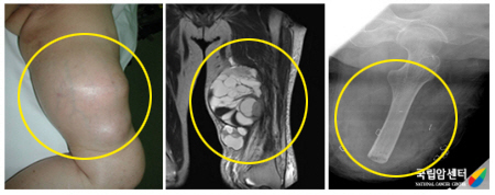 왼쪽 대퇴부의 악성말초신경초종 환자의 절단술 전후 사진