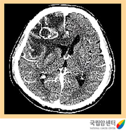 CT상 전이성 뇌종양