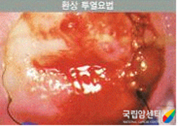 환상투열요법의 예