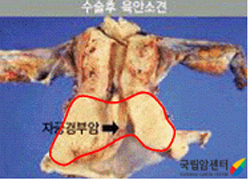 광범위 자궁적출술 후 육안소견
