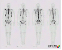 다발성 전이가 있는 전립선암의 골스캔 소견
