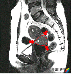 질 상부를 침범한 자궁경부암 환자의 MRI 소견