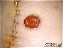 장루 주머니 교환 방법(1)