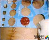 장루주머니 교환 방법(2)