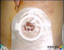 장루주머니 교환 방법(10)