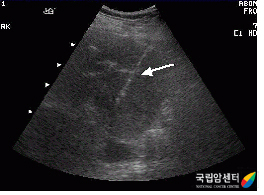 신종양에 대한 생검