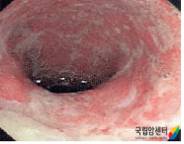 궤양성 대장염