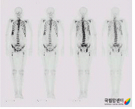 다발성 전이가 있는 전립선암의 골스캔 소견