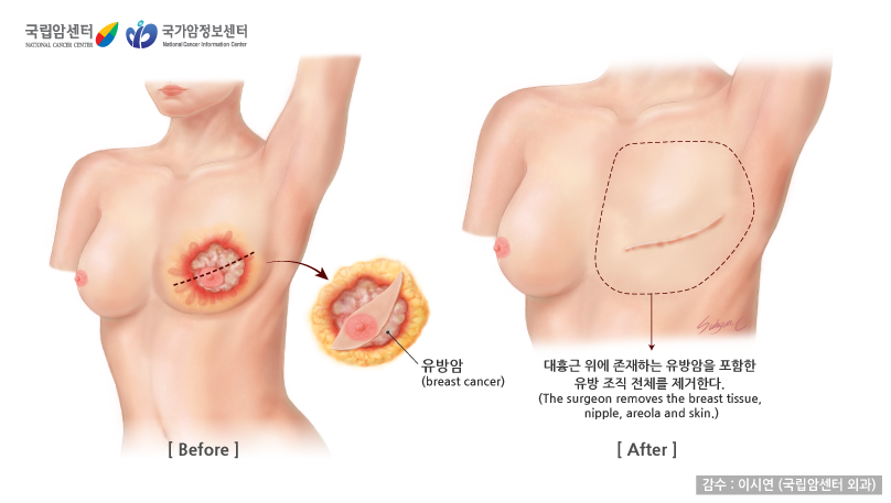 유방암 1년차 적응기 - 유방암 브라, 인공유방, 림프부종