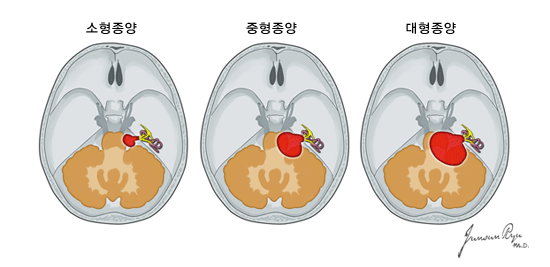 청신경초종의 크기에 따른 분류 - 소형종양, 중형종양, 대형종양