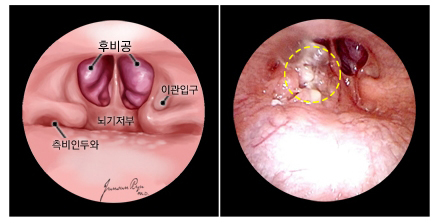 정상 비인두 (후비공, 이관입구, 뇌기저부, 측비인두) 와 비인두암