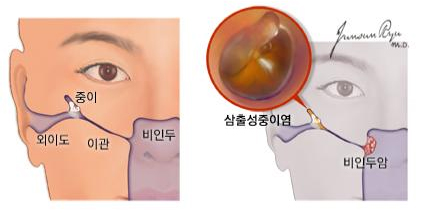 비인두암과 삼출성 중이염 - 중이, 외이도, 이관, 비인두, 삼출성중이염, 비인두암