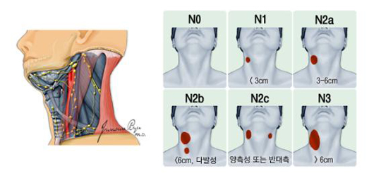경부 림프절 전이와 그 병기 (AJCC, 2010)  - NO, N1기 3cm 미만, N2a기 3~6cm, N2b 6cm 미만, 다발성,  N2c기 양측성 또는 반대측, N3기 6cm 이상