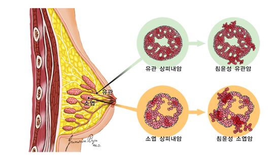 유방암의 종류 - 유관, 유관 상피내암, 침윤성 유관암, 소엽, 소엽 상피내암, 침윤성 소엽암