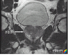 전립선암의 MRI 소견