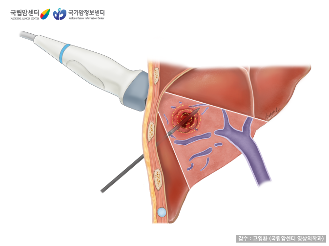 [국립암센터/국가암정보센터] 간 고주파열치료 - 감수 : 고영환(국립암센터 영상의학과)