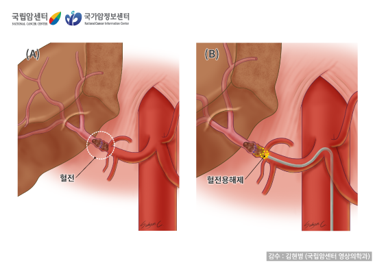 [국립암센터/국가암정보센터] 간동맥 혈전증과 치료 - 감수:김현범(국립암센터 영상의학과)
