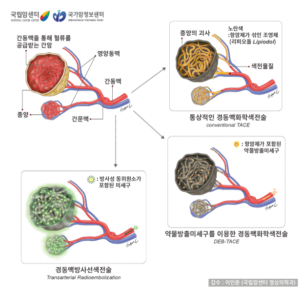 [국립암센터/국가암정보센터] 경동맥색전술의 종류 - 통상적인 경동맥화학색전술(conventional TACE), 약물방출세미구를 이용한 경동맥화학색 전술(DEB-TACE), 경동맥방사선색전술(Transarterial Radioembolization) - 감수 : 이인준(국립암센터 영상의학과)