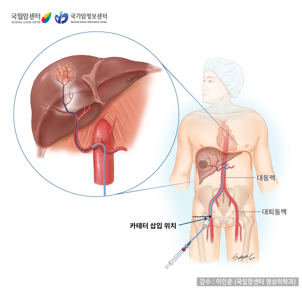 [국립암센터/국가암정보센터] 경동맥화학색전술 - 카테터 삽입 위치 - 감수 : 이인준(국립암센터 영상의학과)