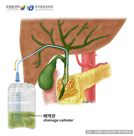 [국립암센터/국가암정보센터] 경피경간담즙배액술 - 감수:이재환(국립암센터 영상의학과)