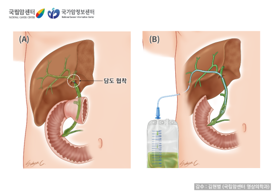 [국립암센터/국가암정보센터] 담도협착과 치료 - 감수:김현범(국립암센터 영상의학과)