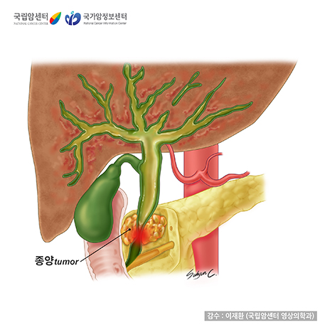 [국립암센터/국가암정보센터] 암으로 인해 총담관 부위가 막힌 상태 - 감수:이재환(국립암센터 영상의학과)