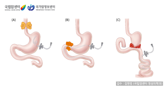 [국립암센터/국가암정보센터] 장관 영양공급을 위한 인터벤션 - 감수:김현범(국립암센터 영상의학과)