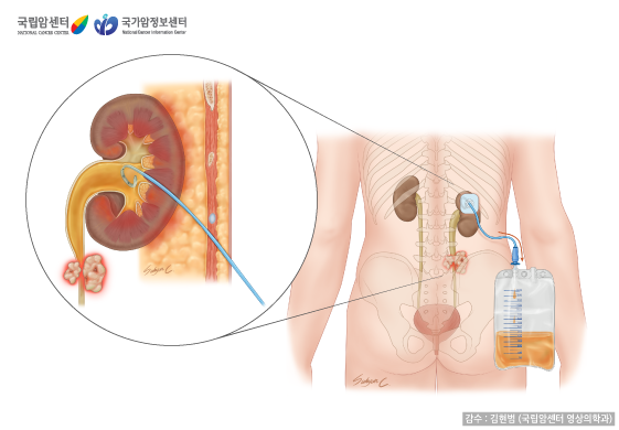 [국립암센터/국가암정보센터] 경피신루형성술 - 감수:김현범(국립암센터 영상의학과)